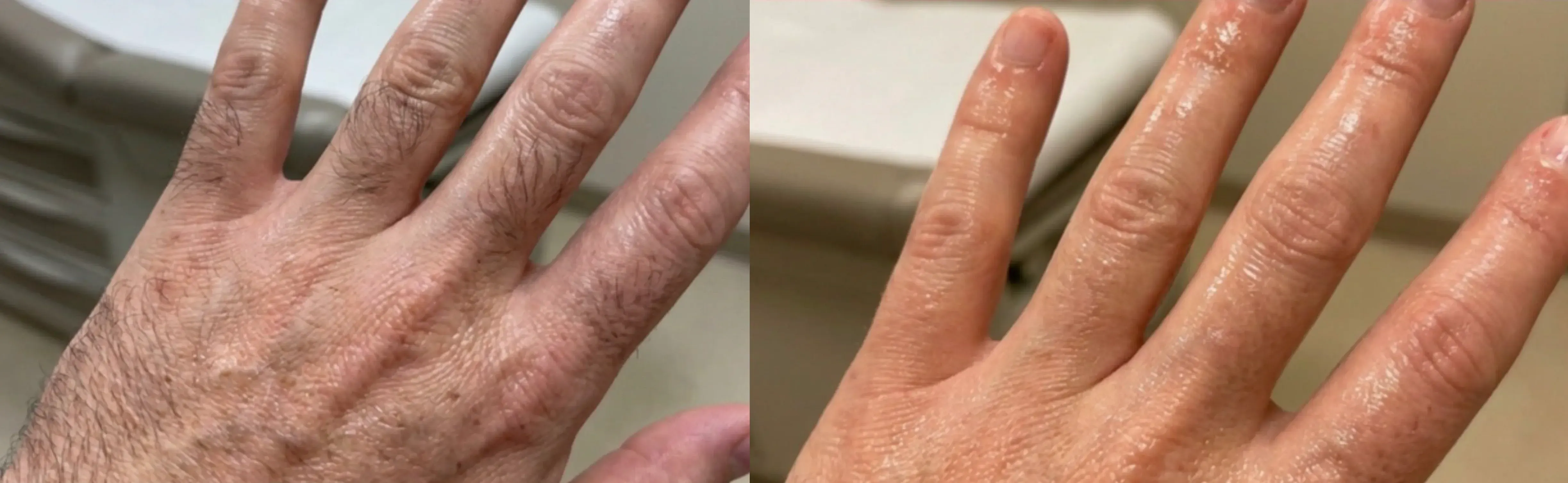 Laser Hair Removal Elite iQ | Cambridge, MA — Before and After