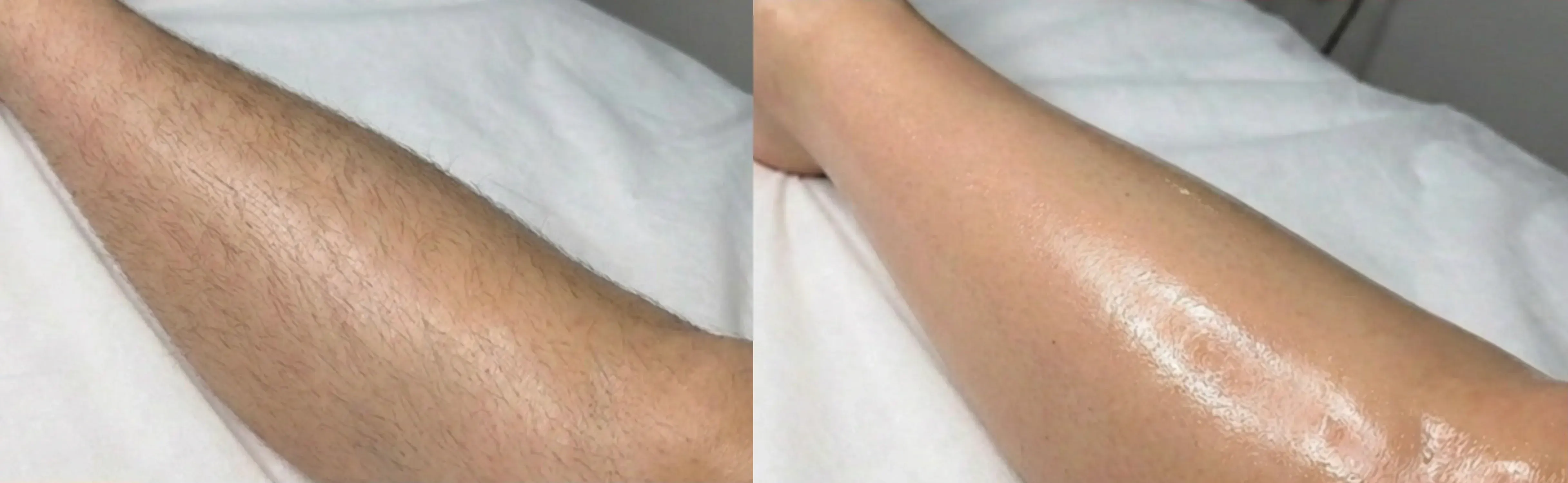 Laser Hair Removal GentleMax Pro | Boston, MA — Before and After