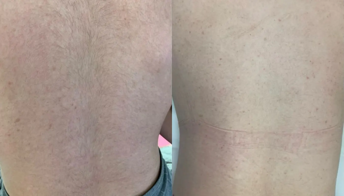 Laser Hair Removal GentleMax Pro | Boston, MA — Before and After