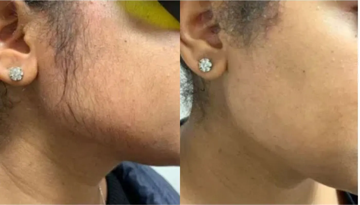Laser Hair Removal Elite iQ | Cambridge, MA — Before and After