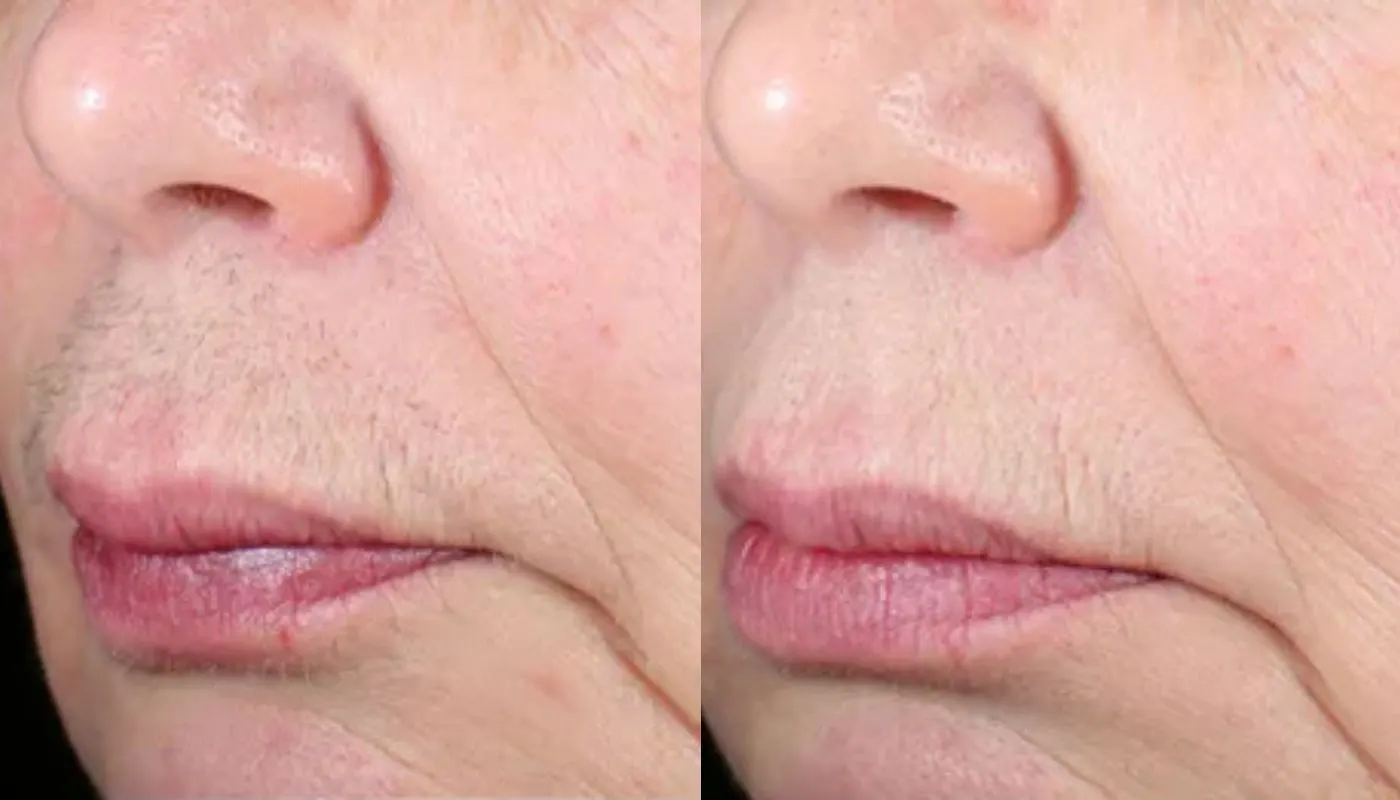 Laser Hair Removal Elite iQ | Cambridge, MA — Before and After