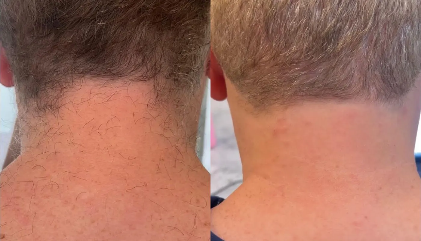 Laser Hair Removal GentleMax Pro | Boston, MA — Before and After