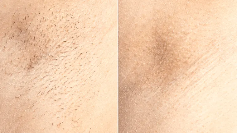 Laser Hair Removal Elite iQ | Cambridge, MA — Before and After